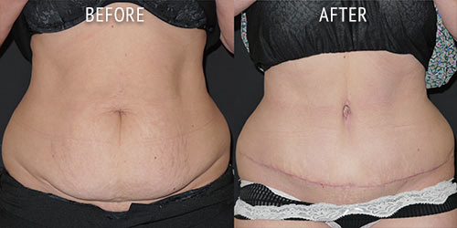 abdominoplasty surgery before and after patient results front view photo at Cosmetic Surgery Partners London
