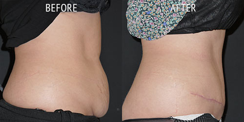 abdominoplasty surgery before and after patient results side view photo at Cosmetic Surgery Partners London