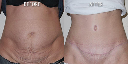 abdominoplasty surgery before and after patient results front view photo at Cosmetic Surgery Partners London