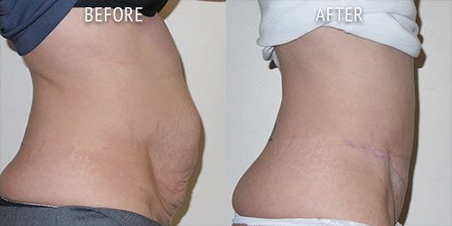 abdominoplasty surgery before and after patient results side view photo at Cosmetic Surgery Partners London