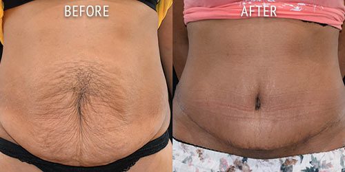 abdominoplasty surgery before and after patient results front view photo at Cosmetic Surgery Partners London