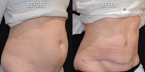 abdominoplasty surgery before and after patient results oblique angle view photo at Cosmetic Surgery Partners London
